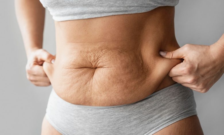 The Main Causes of Cellulite and How to Fight It