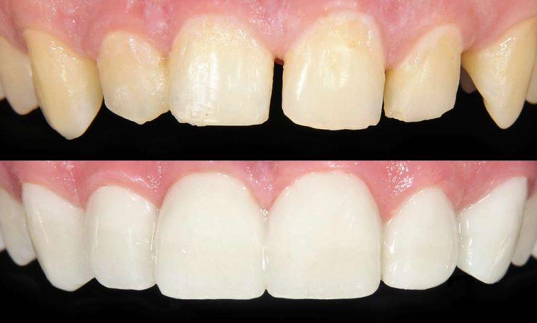 remove dental bonding